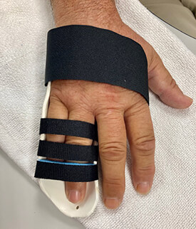 A hand with ring and pinky fingers taped and braced together.